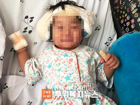 인공달팽이관 수술을 받고 회복 중인 윤호2살 가명