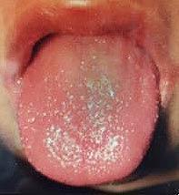 성홍열 증상딸기혀
