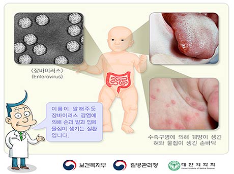 수족구병 출처 질병관리청 국가건강정보포털