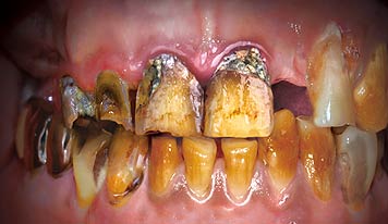 치아변색으로 가는 길