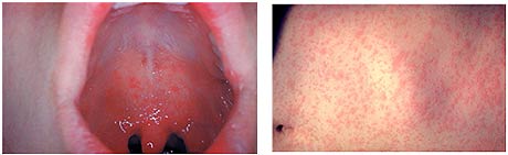  구강 내 Koplik 반점  홍역 발진