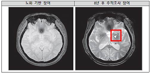 8년 후 뇌 미세출혈이 발생한 뇌영상 이미지 